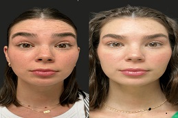 Botox image before and after 