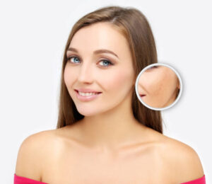 Chemical Peels in Dubai