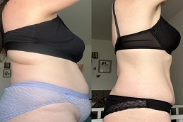 Generic Mounjaro in Islamabad before & After