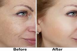 Laser Hair Removal Before and after