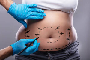 Liposuction in Dubai