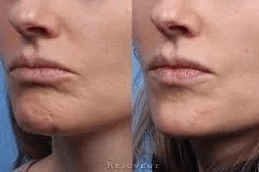 Botox image before and after 