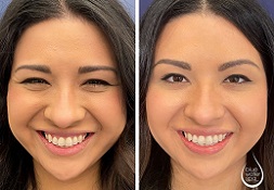 Botox image before and after 