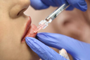 Lip Fillers injection in Dubai