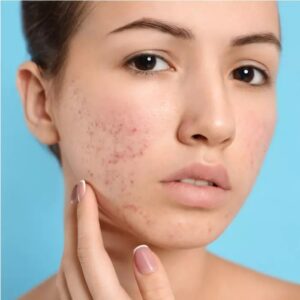 Acne Scar Treatment