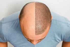 Unraveling the True Worth of Hair Transplant Investment in Dubai