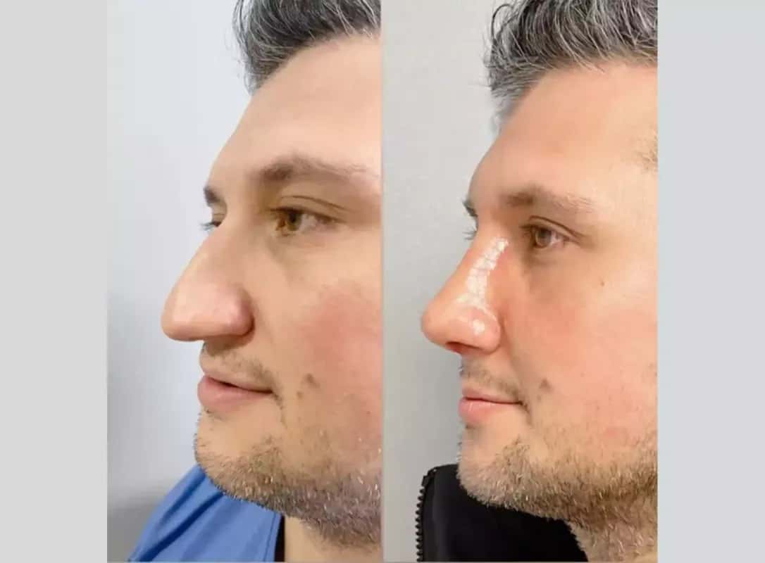 male with nose surgery