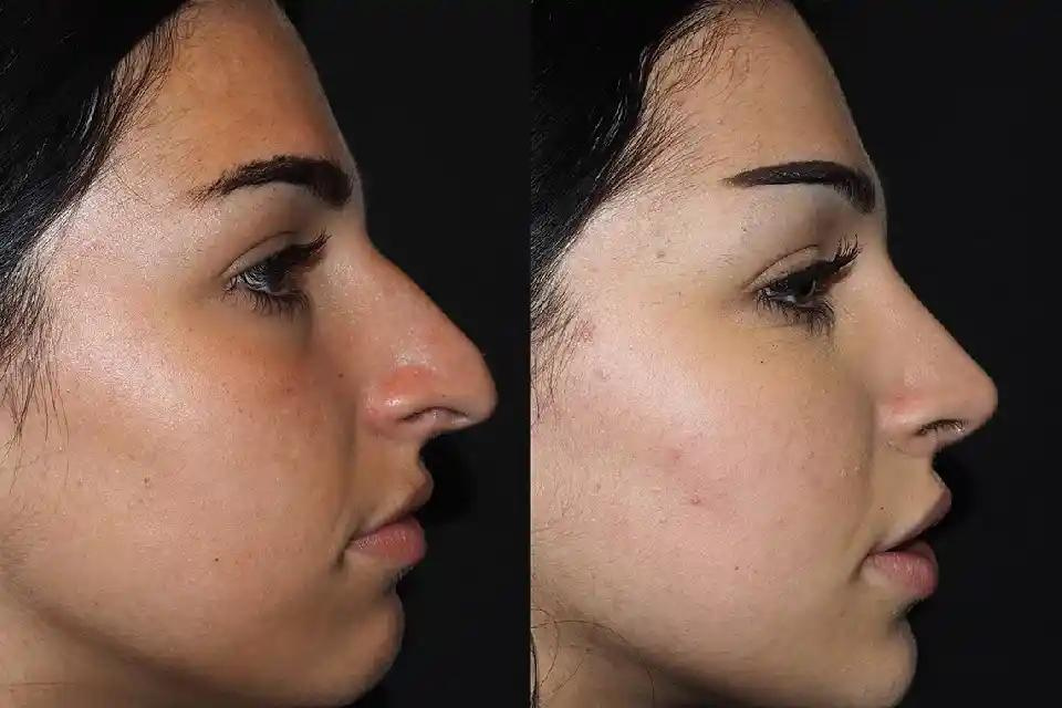 Rhinoplasty in Dubai Uncovered: Your Go-To Information Source