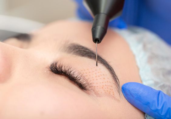 The Power of Eyelid Surgery: How to Harness Its Potential