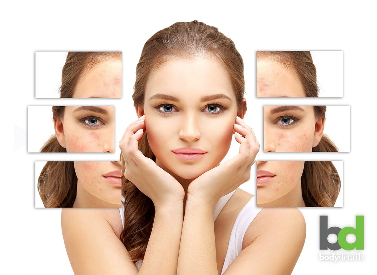 Acne Scars Treatment in Dubai