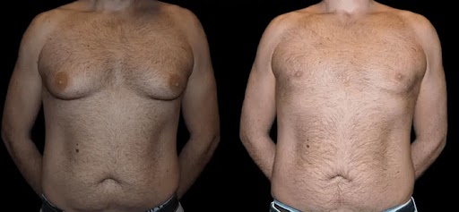 before and after male breast reduction photos