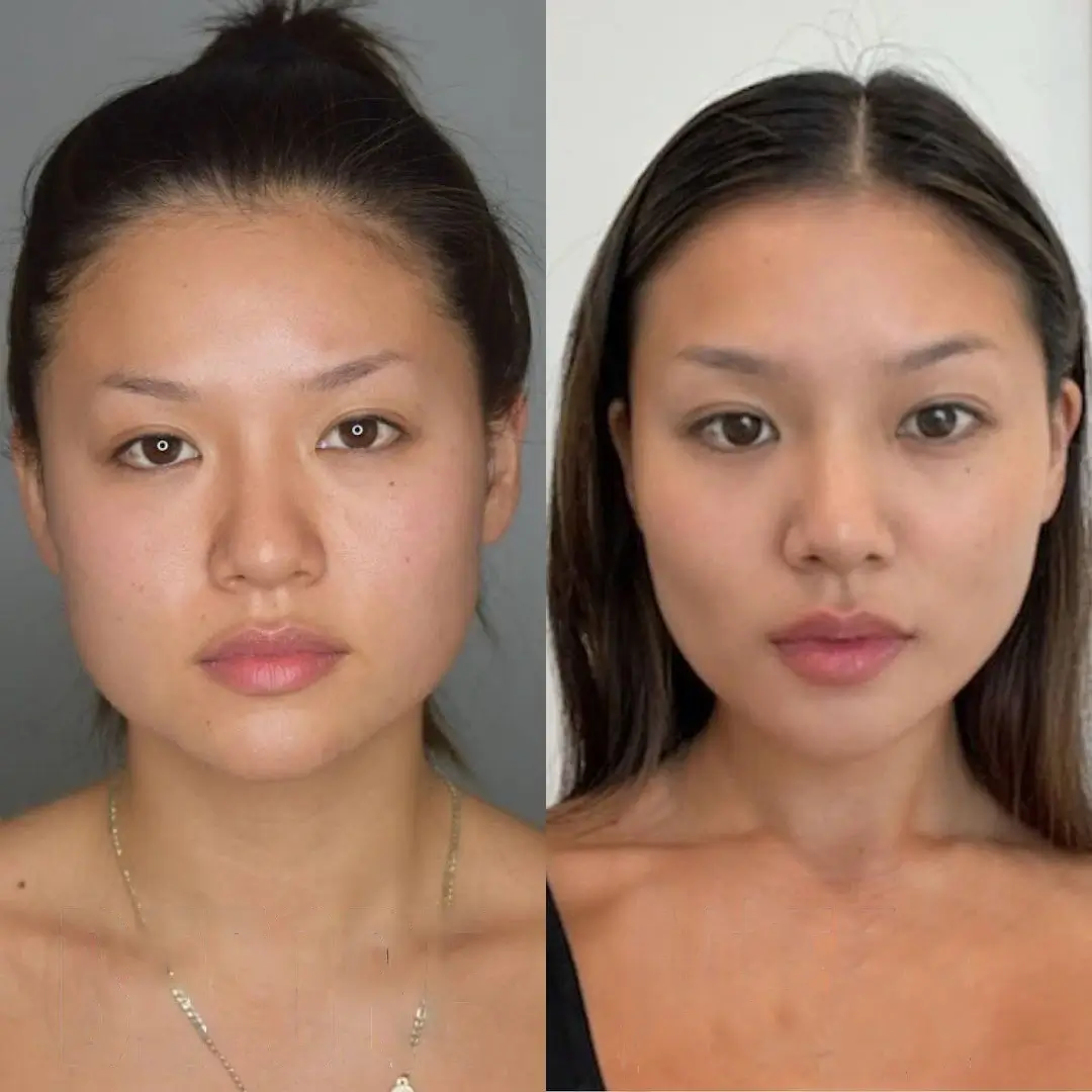 Before and after image of a female buccal fat removal