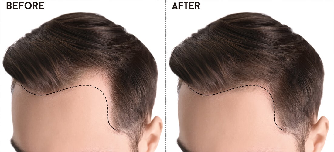 Hair Transplant in Islamabad: A Comprehensive Guide to Achieving a Fuller Head of Hair