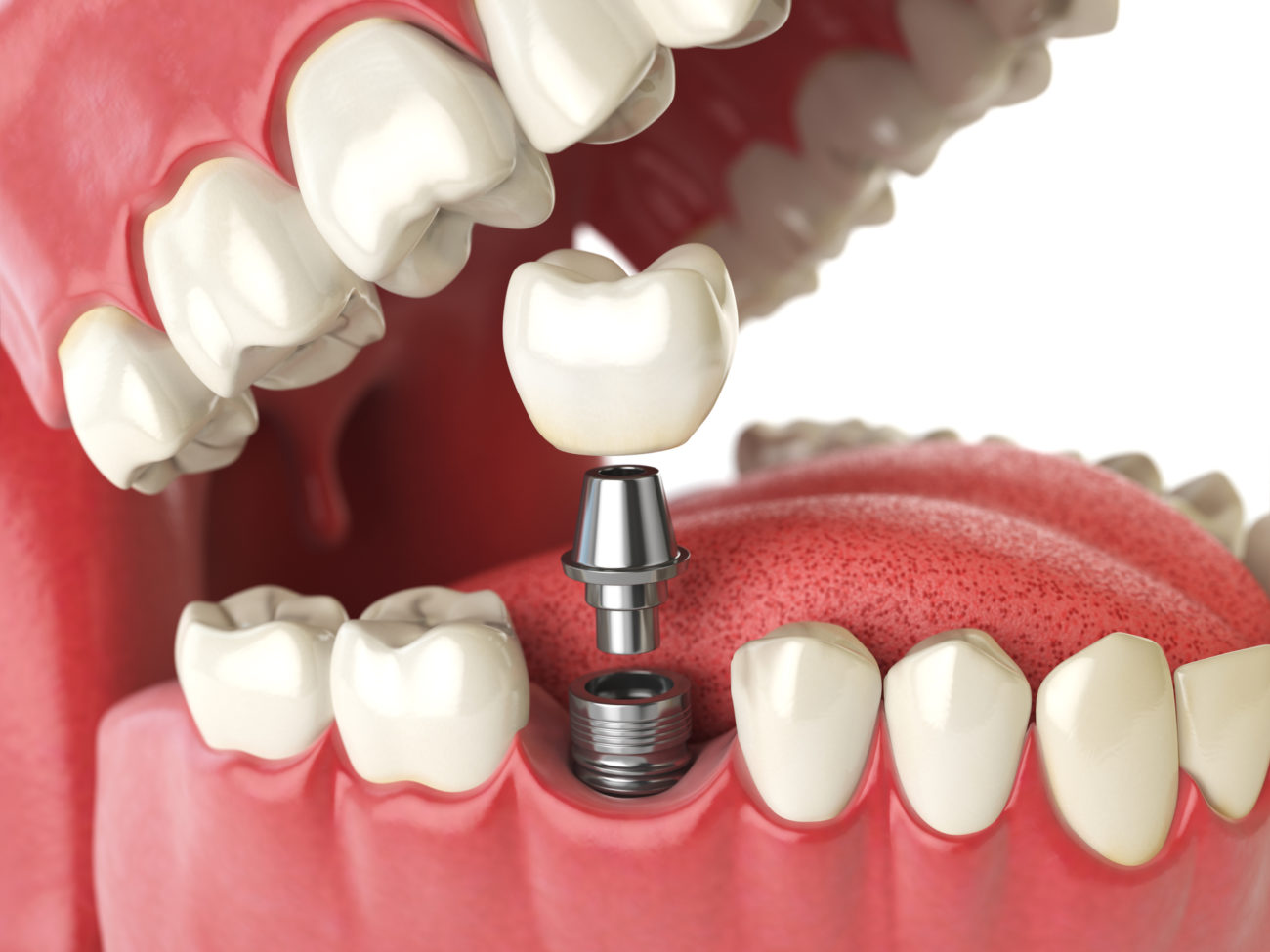 Understanding the Cost of a Single Tooth Implant in Delhi: What You Need to Know