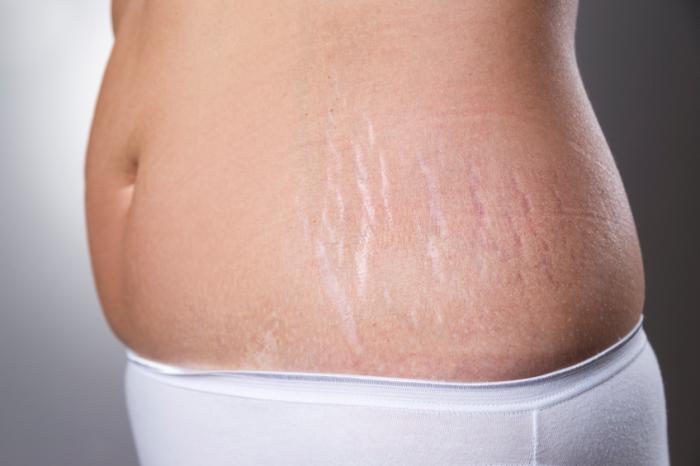 Stretch Marks Treatment Cost in India: What You Need to Know