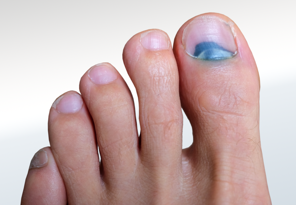 Why Should You Consider Ingrown Toenail Matricectomy for Chronic Pain?