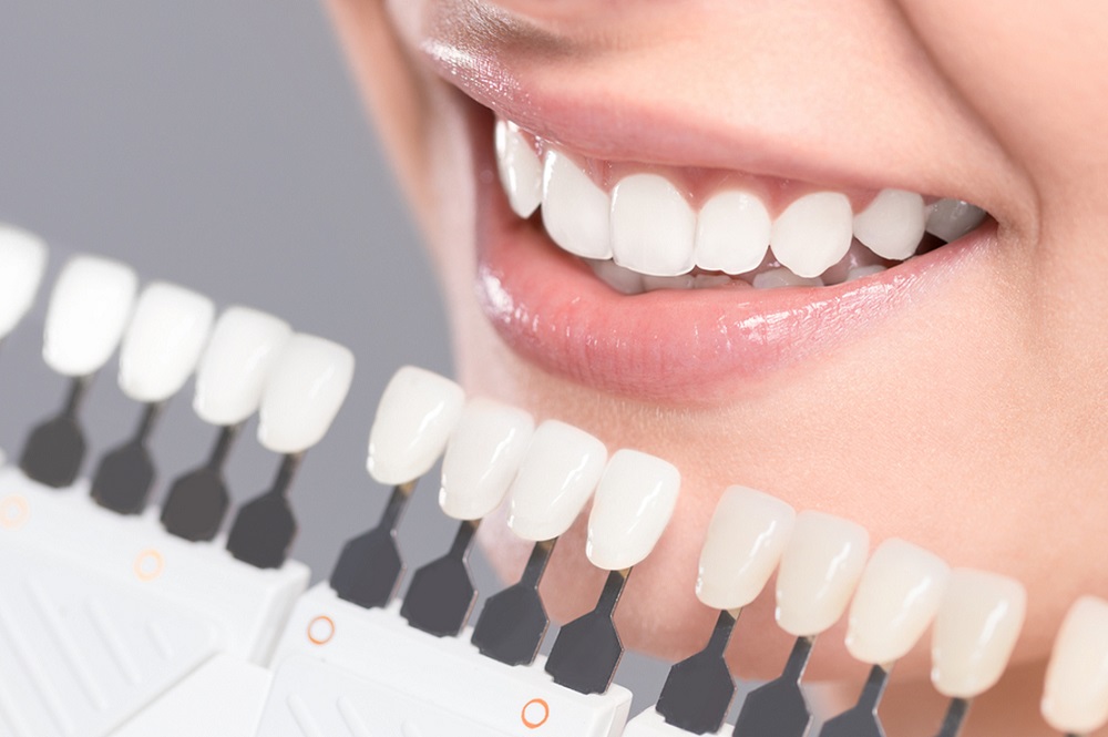 The Benefits of Choosing Composite Veneers for Your Transformation in Dubai