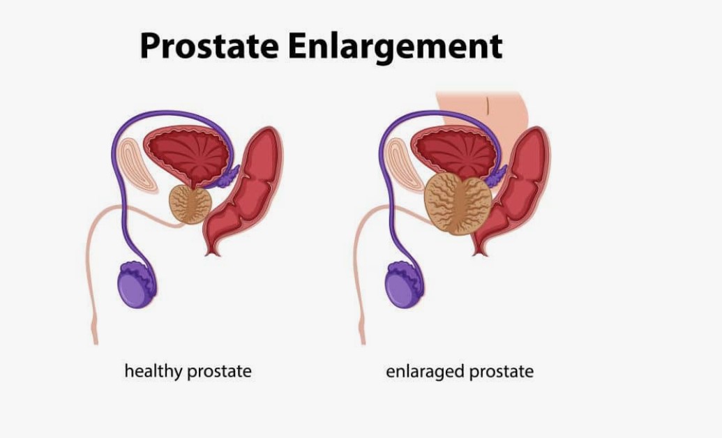 Enlarged Prostate