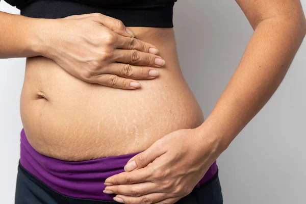 Precautions for Laser Stretch Marks Treatment in Dubai