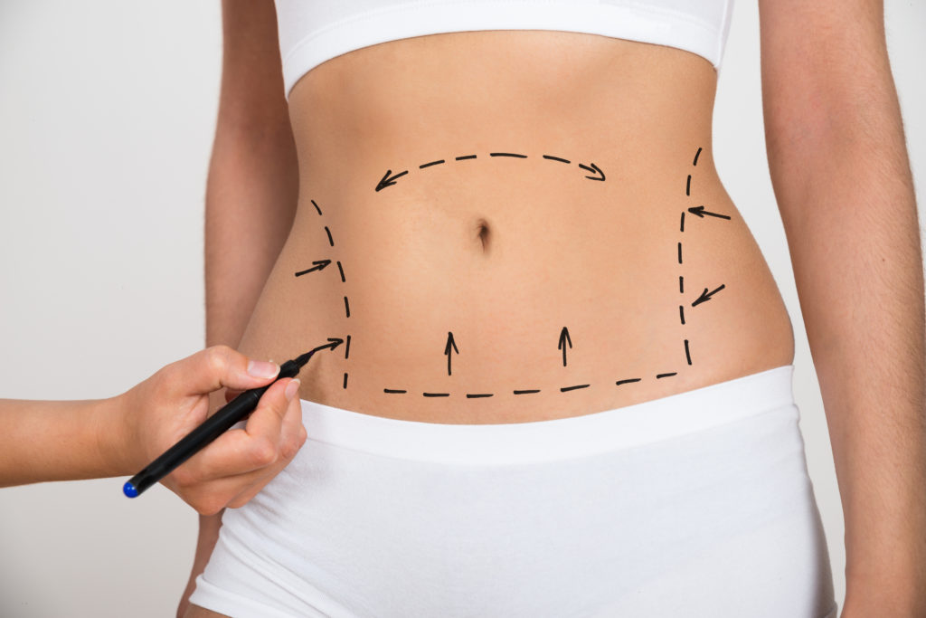 How Soon Can I see The Final Results of Liposuction Surgery in Dubai