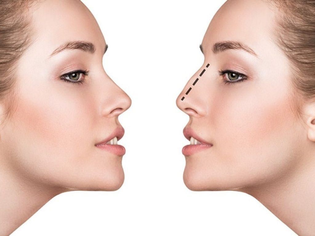 Rhinoplasty Recovery in Dubai: Expert Tips