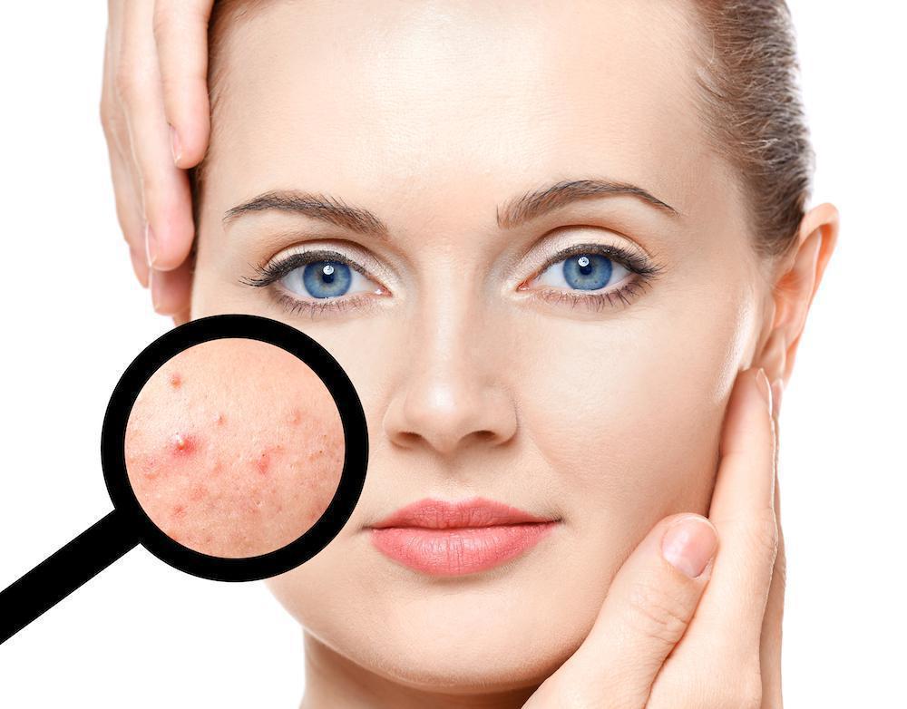 Acne Cure Transform Your Skin With Powerful Solutions