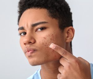 acne-scars-treatment