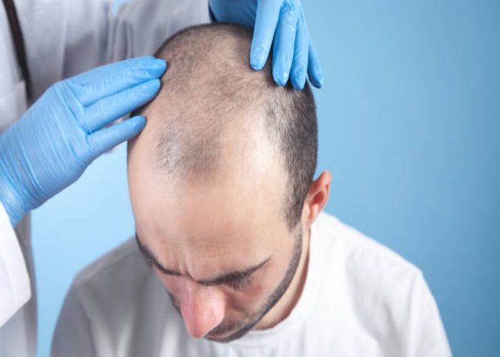 تكلفة زراعة الشعر في دبي