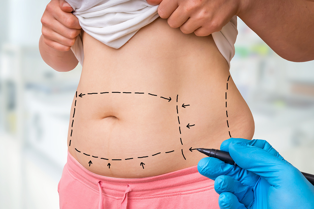 10 Must-Know Facts About Liposuction Surgery in Dubai