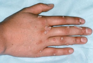 What Are Warts and How Can They Be Treated in Islamabad?