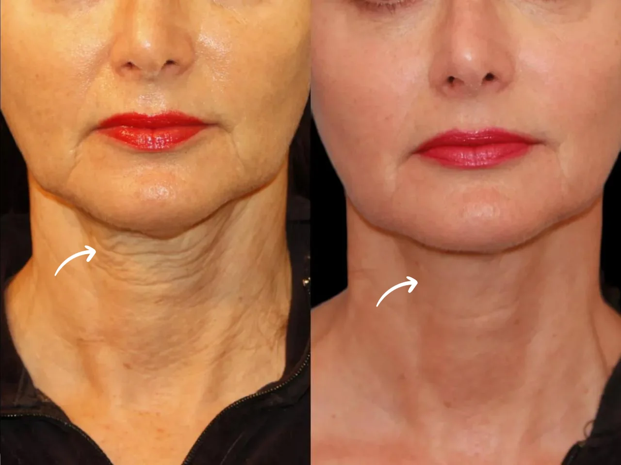 Why the Best Aesthetic Clinic in dubai Recommends Sculptra for Volume Restoration