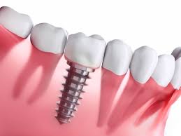 Dental Implants: A Permanent Solution for Missing Teeth