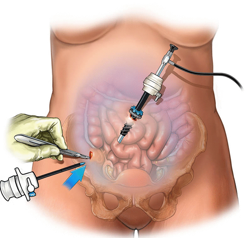 Laparoscopic Surgery in riyadh