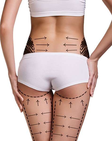 A New You Awaits: Best Liposuction Surgery in Riyadh