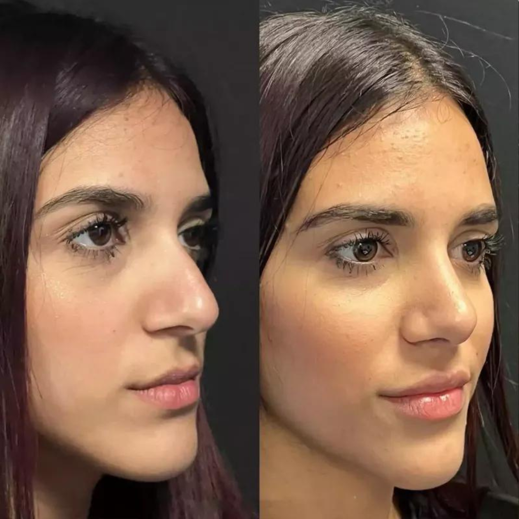 Experience Rhinoplasty in Dubai: Expert Care