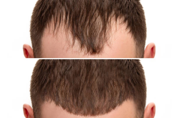 Take the First Step with Hair Transplant in Riyadh