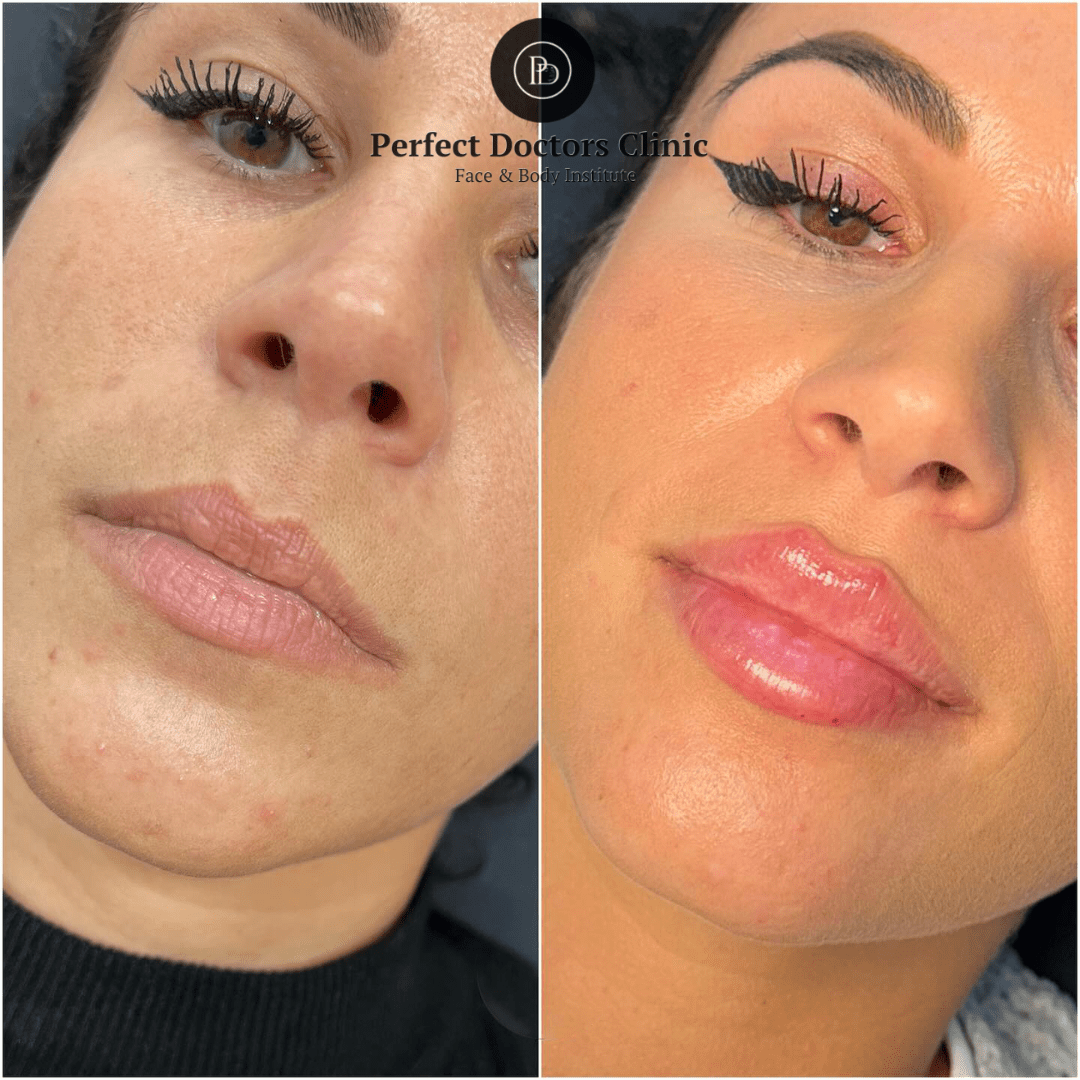 How to Book a Consultation with the Best Doctors in dubai for Juvederm