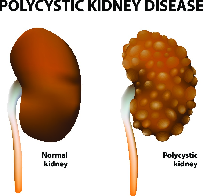 Polycystic Kidney Disease