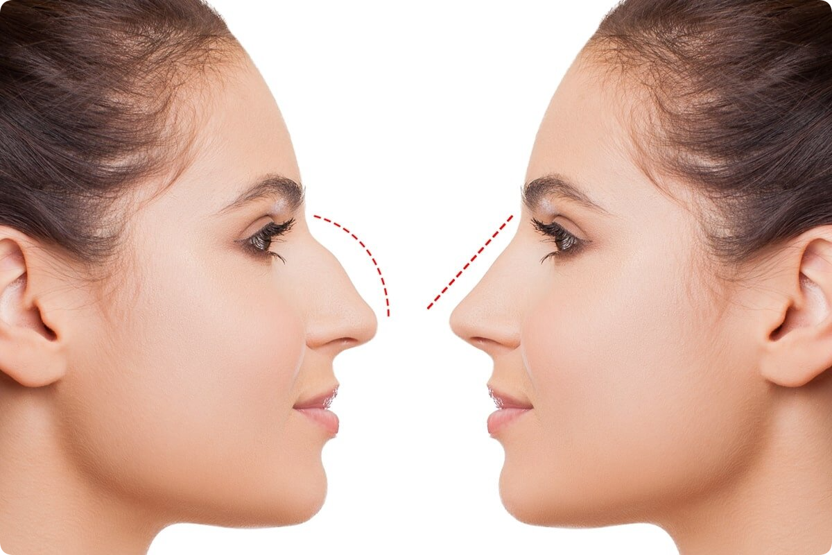 Rhinoplasty in Dubai: Is It Worth It?