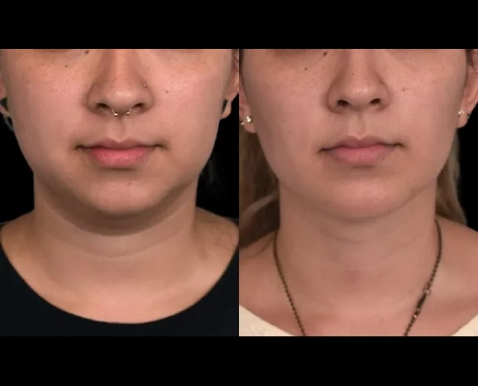 Double chin removal