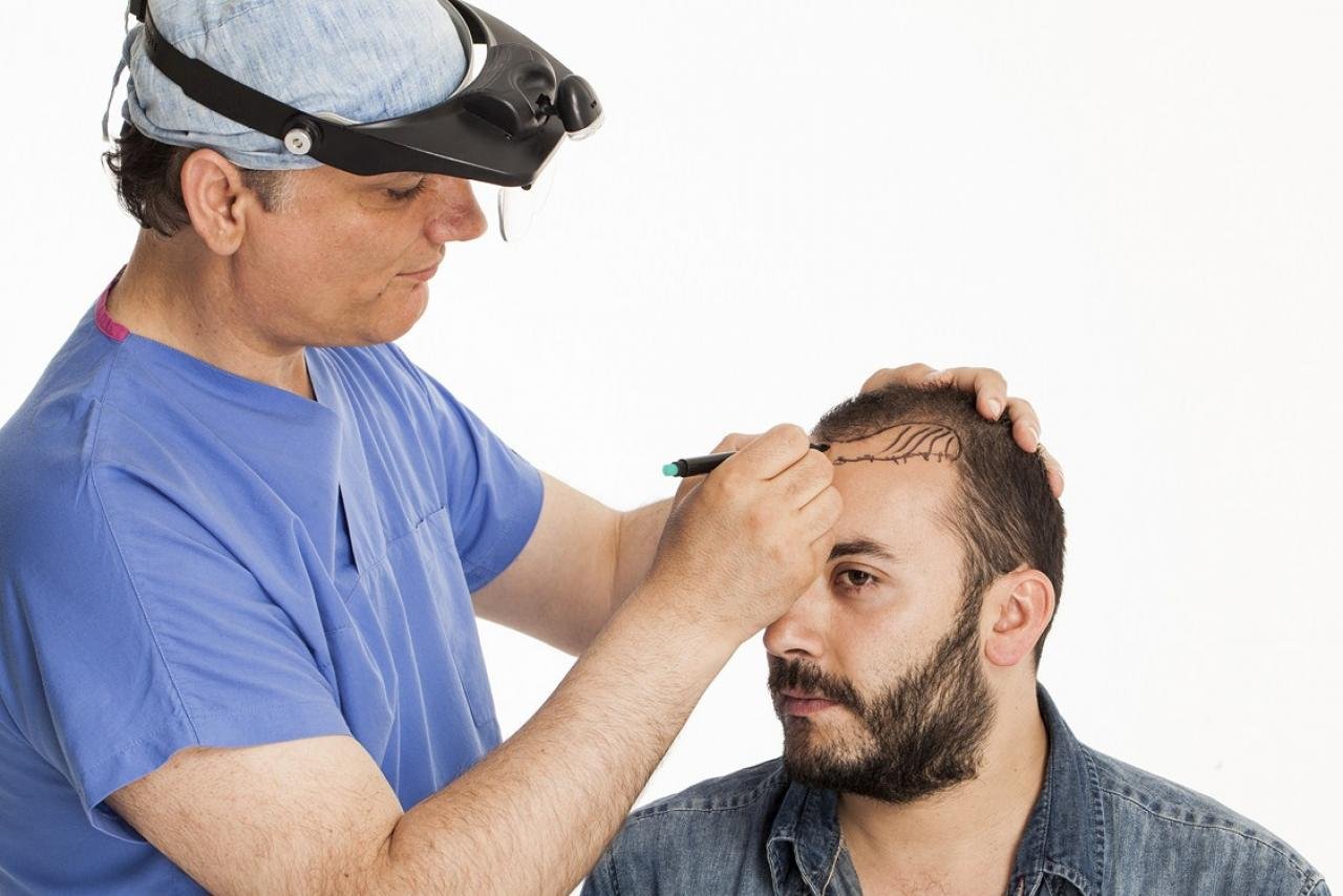 How to Correctly Manage Your Hair Transplant Aftercare?