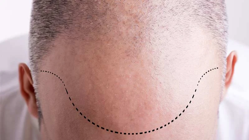 What Is The Best Prp Hair Restoration Clinic In Dubai?