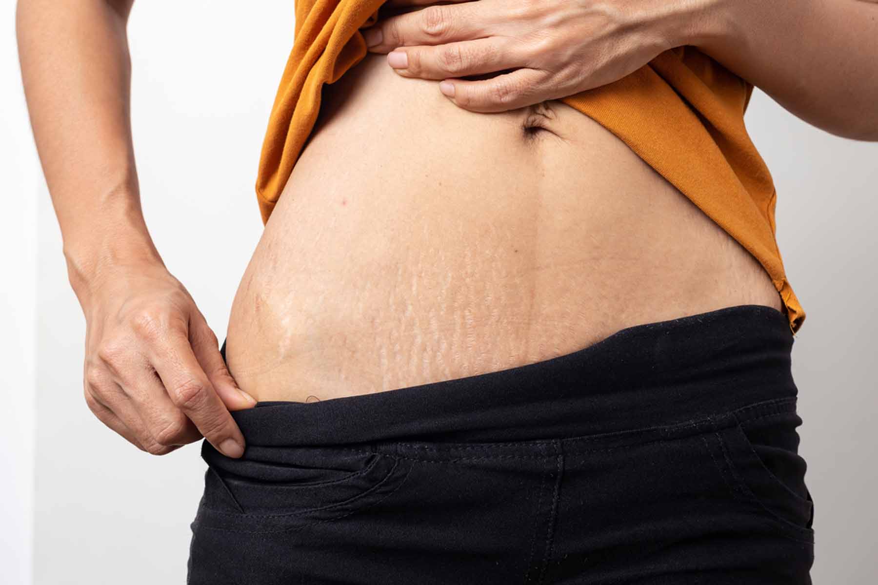 Laser Stretch Marks Treatment in Dubai