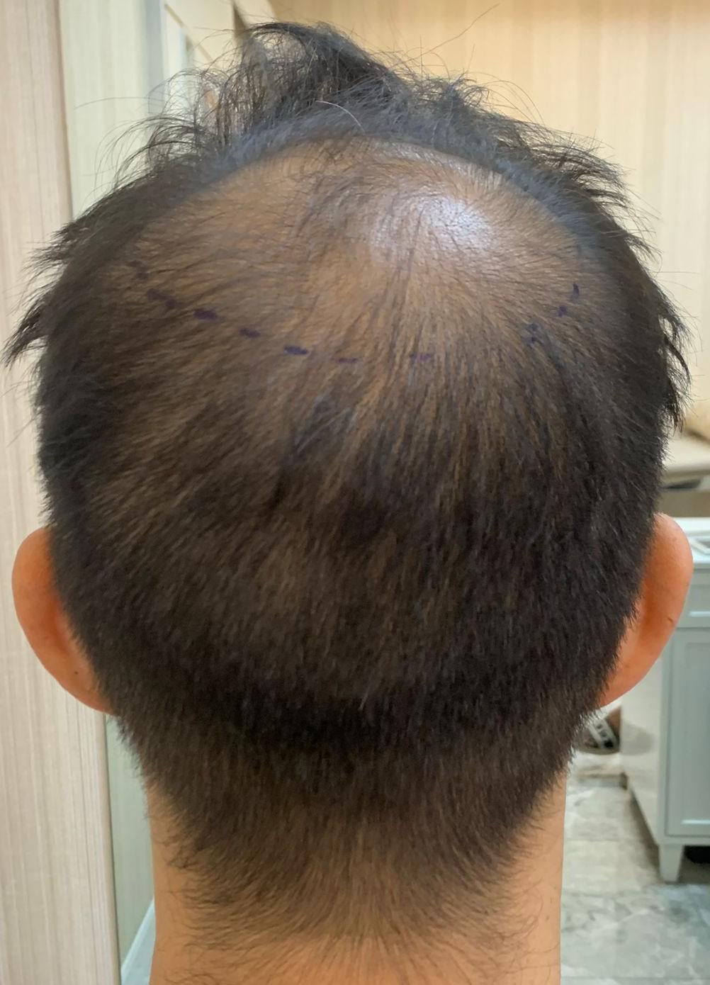 The Latest Hair Transplant Technology