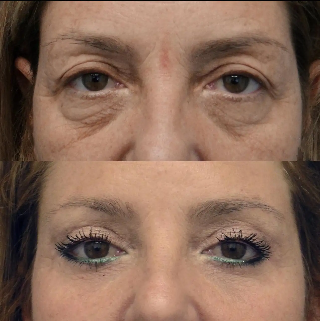 Eye bag removal