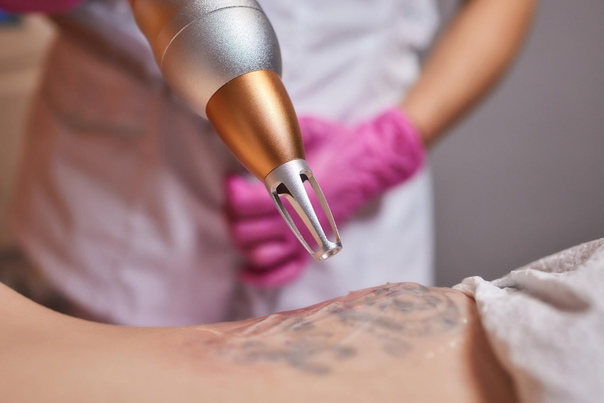 Tattoo Removal Services in Brooklyn NY