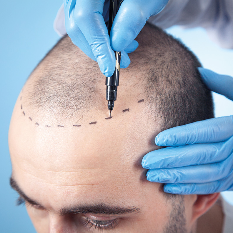 Who Is a Poor Candidate for Hair Transplant?