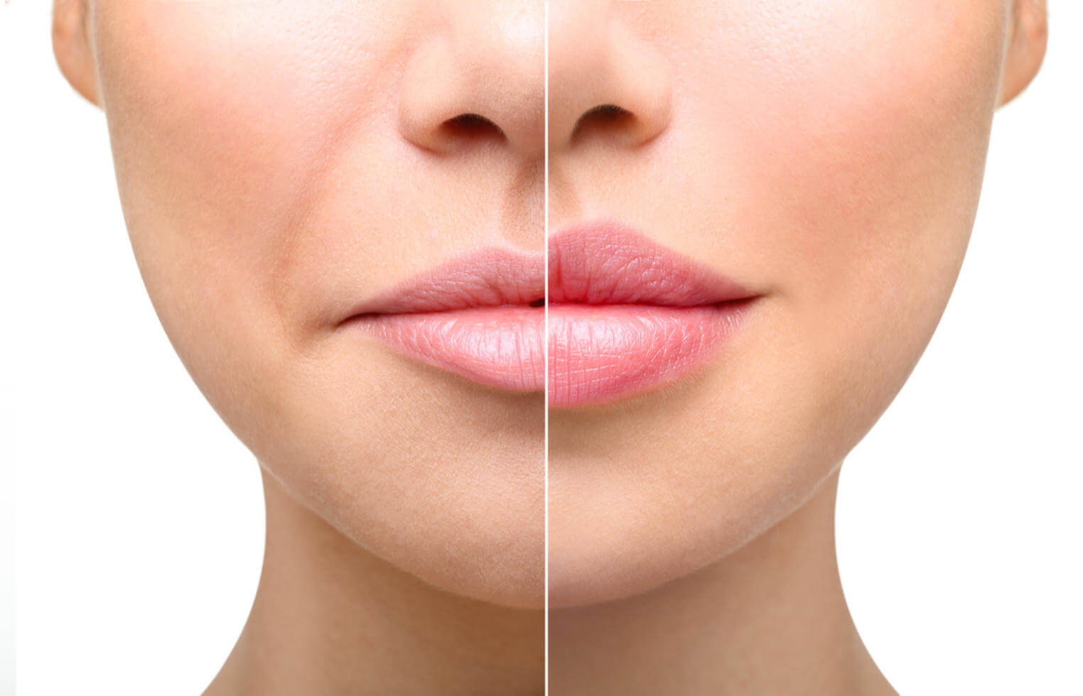 Lip Augmentation in Islamabad: Quick Procedure, Lasting Results