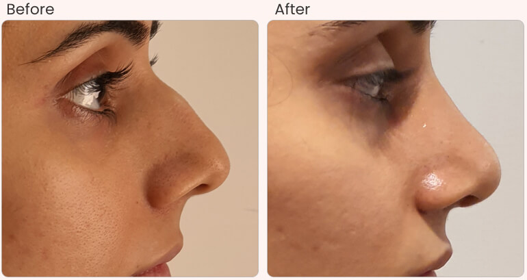 nose plastic surgery in delhi