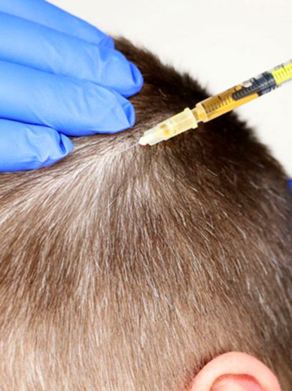 A Guide to PRP Therapy for Hair Loss